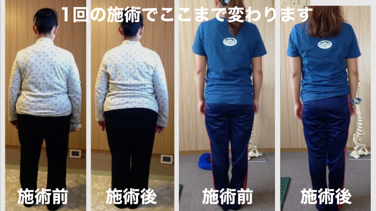 1回の施術でここまで変わる 腰痛 整体ビフォーアフター 岩国市