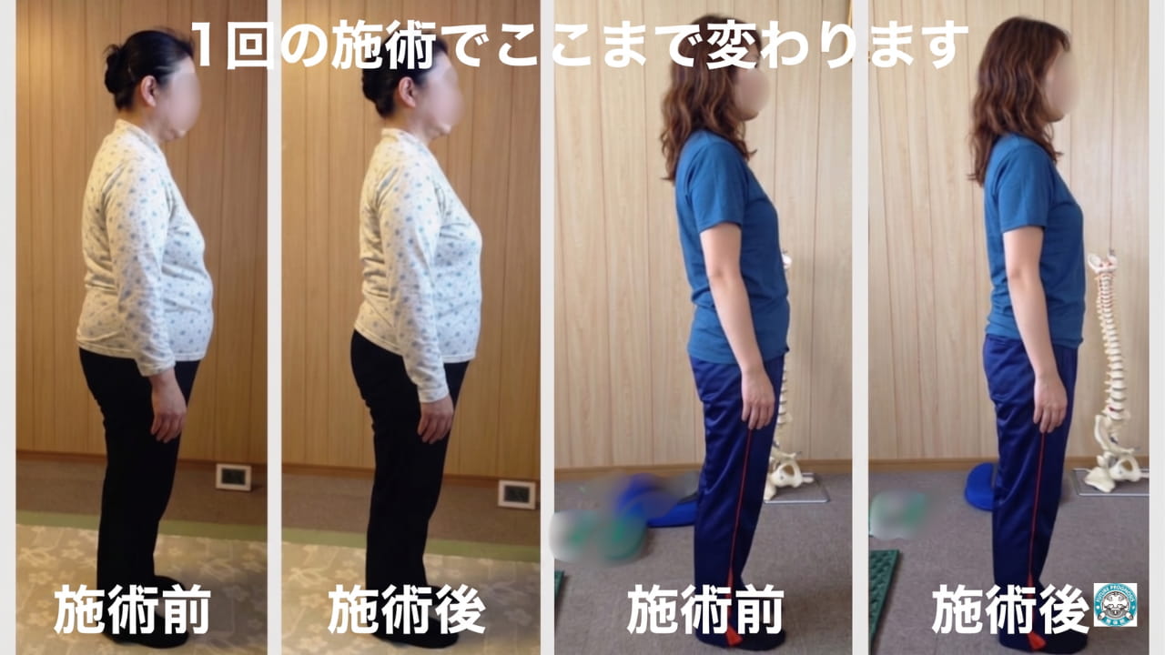 腰痛整体ビフォーアフター 横から見た施術前後の変化 岩国市 太子堂整体院